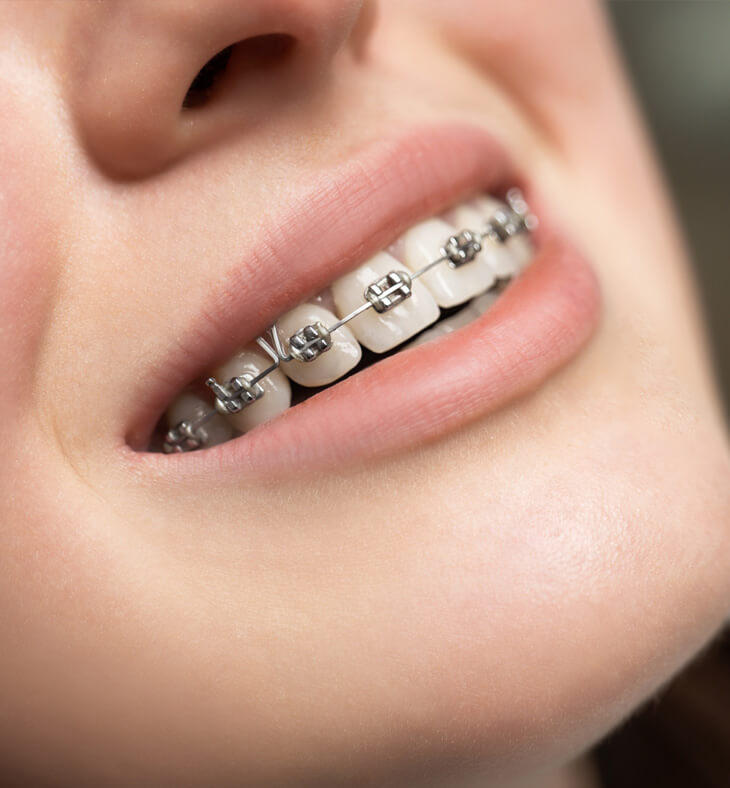 braces 2